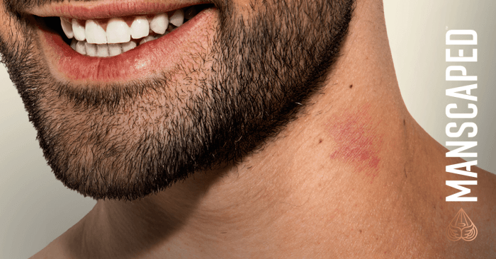 How to get rid of hickeys