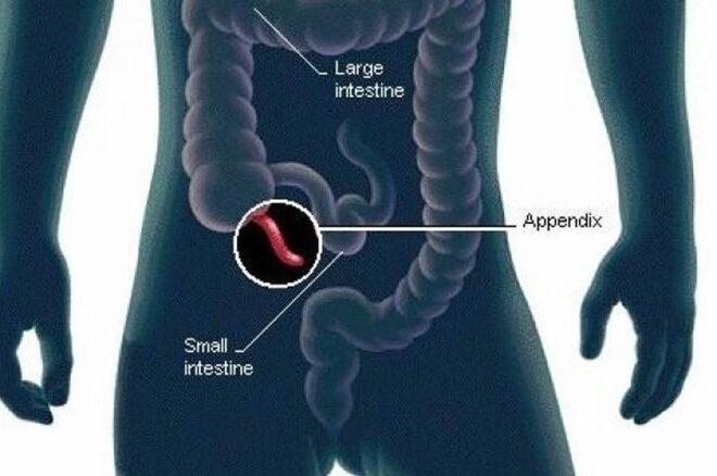 Which Side Is Your Appendix On: An Anatomical Journey