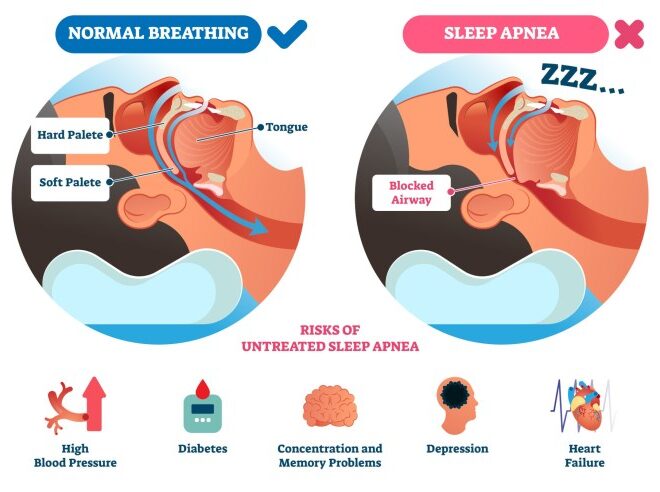 What Is Sleep Apnea: Unveiling the Silent Sleep Disruptor