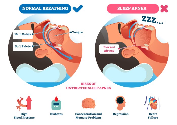 What is sleep apnea